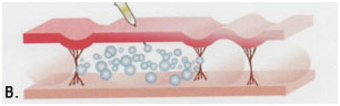 2-karboksiterapia-strii-po-korema-hansha-bedrata-laser-clinic-paris