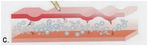 3-karboksiterapia-strii-po-korema-hansha-bedrata-laser-clinic-paris
