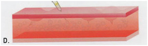 4-karboksiterapia-strii-po-korema-hansha-bedrata-laser-clinic-paris