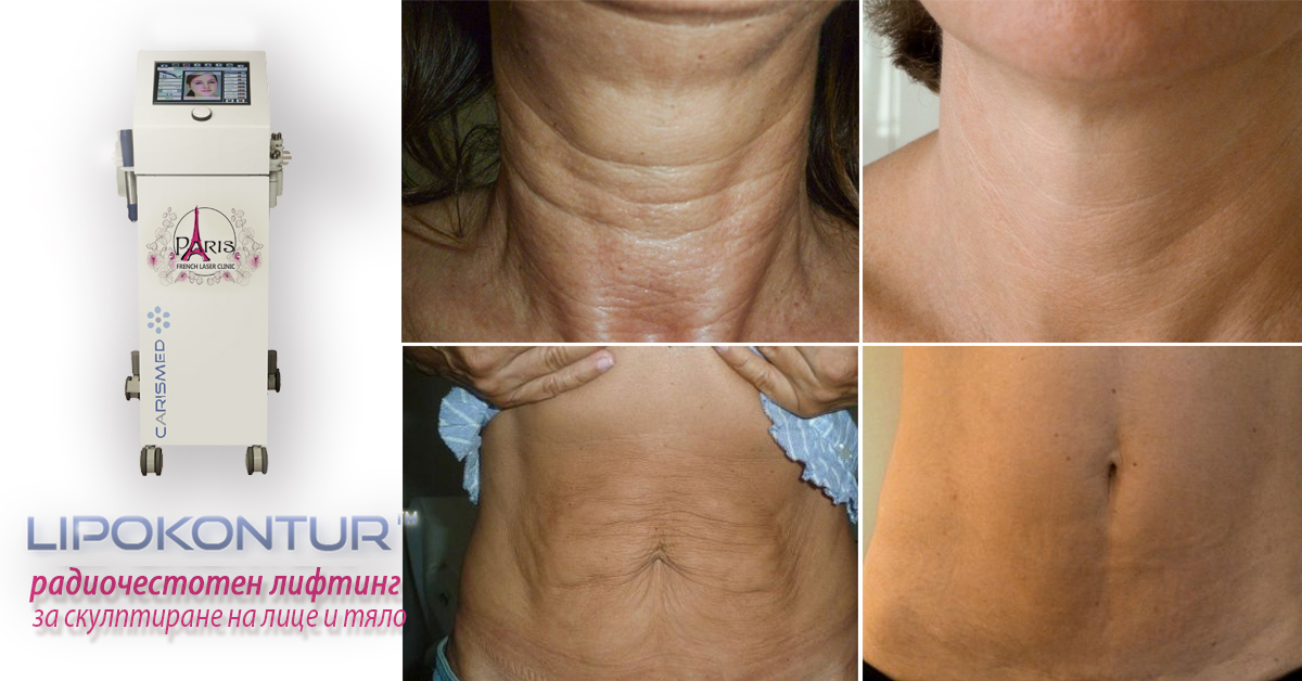 LIPOKONTUR MD- РАДИОЧЕСТОТЕН ЛИФТИНГ с 3 енергии за скулптуриране на лицето и тялото - за борба с бръчките, целулита, стриите, за стягане и повдигане на кожата, отслабване (намаляване на обиколката)