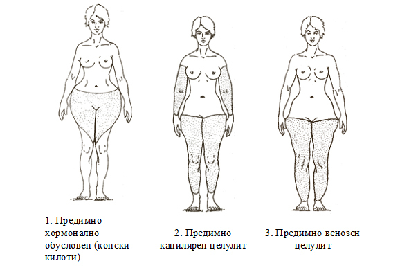 Целулит - как да го премахнем?