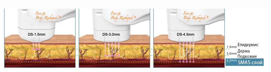 HIFU Face Reshaped® разполага с 3 накрайника - НЕХИРУРГИЧЕН SMAS ЛИФТИНГ НА ЛИЦЕ с високо интензивен фокусиран ултразвук Хайфу (HIFU) - в Лазер Клиник Париж - Варна