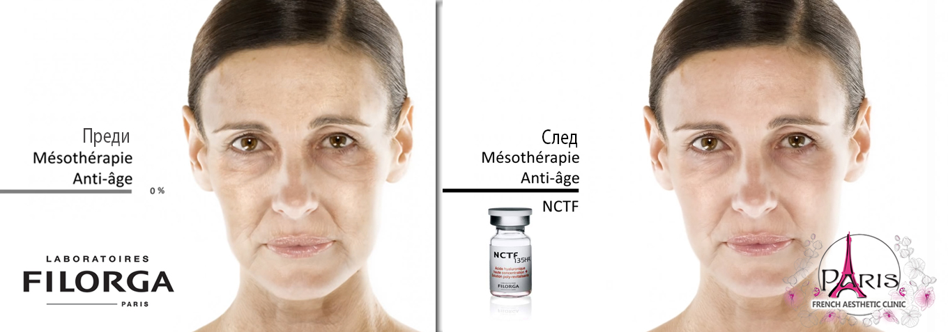 Befor-and-after-Filorga-Peeling-&-NCTF-135HA-2