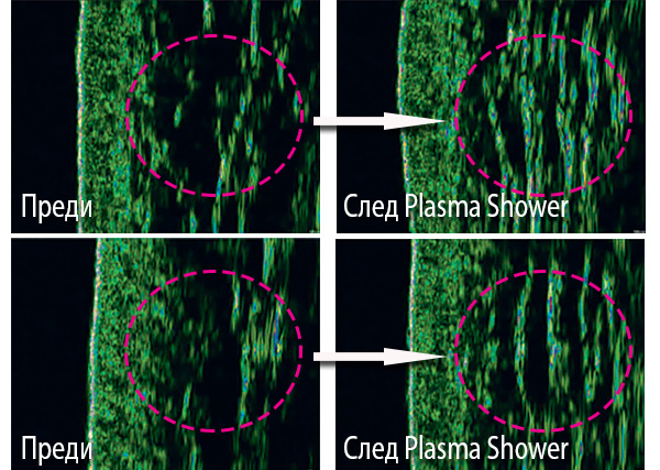 Уплътняване на дермата преди и след Плазма душ (Plasma Shower)