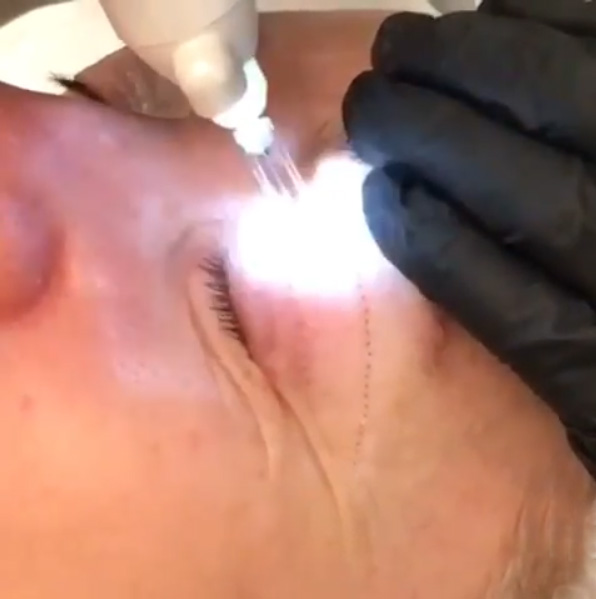 Нехирургична блефаропластика със студена апаратна плазма PlasMeDerm X2 - Процедура