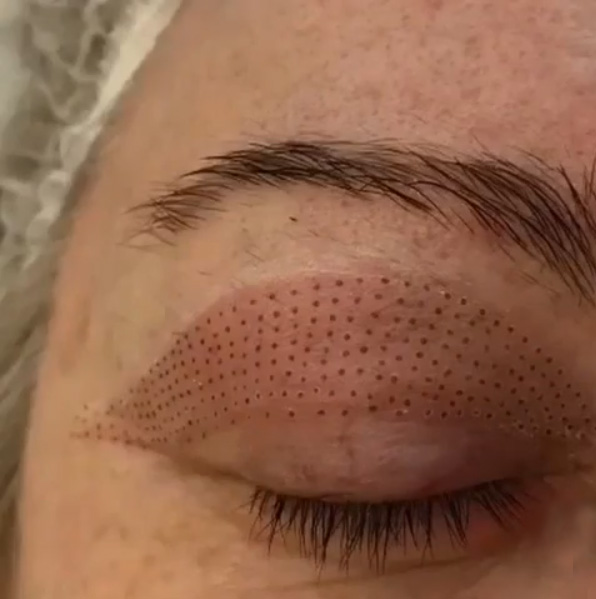 Нехирургична блефаропластика със студена апаратна плазма PlasMeDerm X2 - след процедура